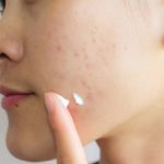 All You Need To Know About Acne Scars