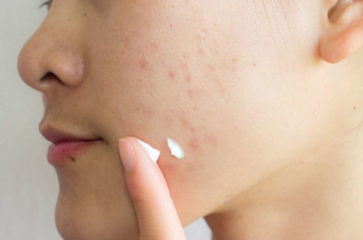 All You Need To Know About Acne Scars