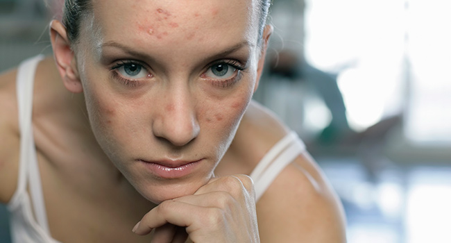 The Differences Between Teen and Adult Acne You Must Know