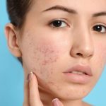 Say Goodbye to Acne Scars with These Revolutionary Non-Surgical Cosmetic Treatments